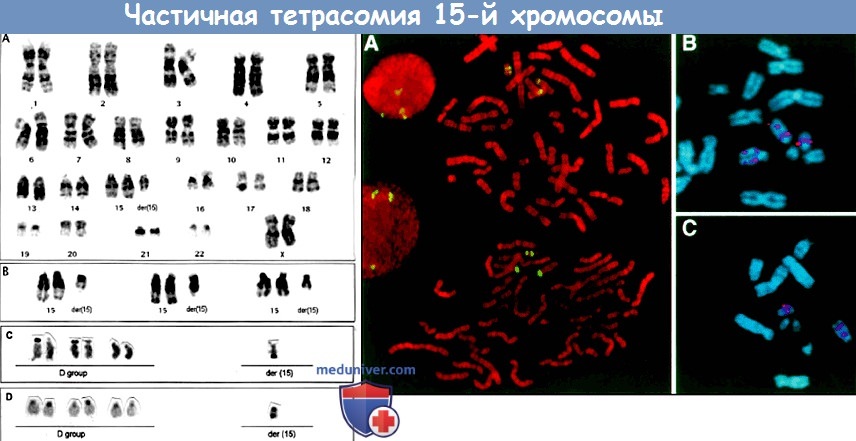 Частичная тетрасомия 15-й хромосомы