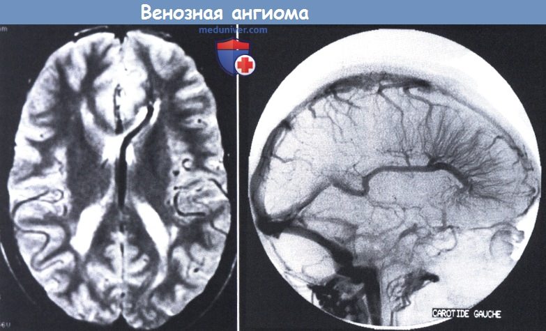 Ангиома правой лобной. Кавернозная ангиома головного. Ангиома сосудов головного мозга. Гроздьевидная ангиома. Капиллярная телеангиэктазия головного мозга мрт.
