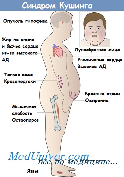 Лечение болезни Иценко-Кушинга в Житомире