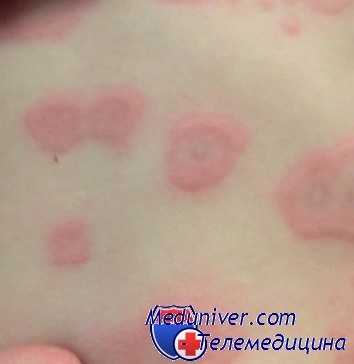аллергия при синдроме стивенса-джонсона