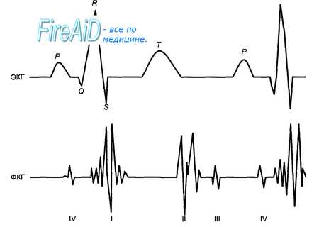 Тоны сердца. Первый ( систолический ) тон сердца. Второй ( диастолический ) сердечный тон. Фонокардиограмма.