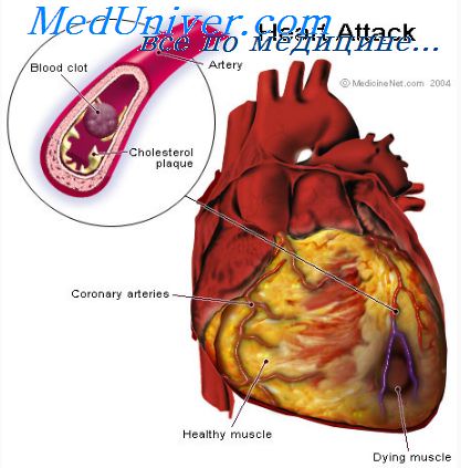 Причины смерти при инфарктах миокарда thumbnail