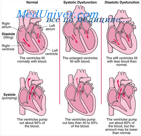 Сердечная недостаточность лечение после инфаркта thumbnail
