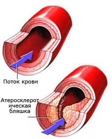 Артерия. Атеросклероз