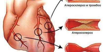 Атеросклероз. Патологические изменения при атеросклерозе.