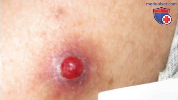 �������������������� ����������� �������� Bartonella (��������� ���������, ����������� ���������� � ���������� �������)