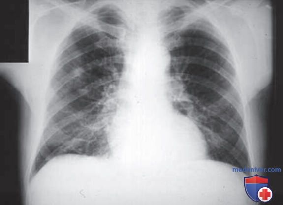 �������� Mycoplasma pneumoniae