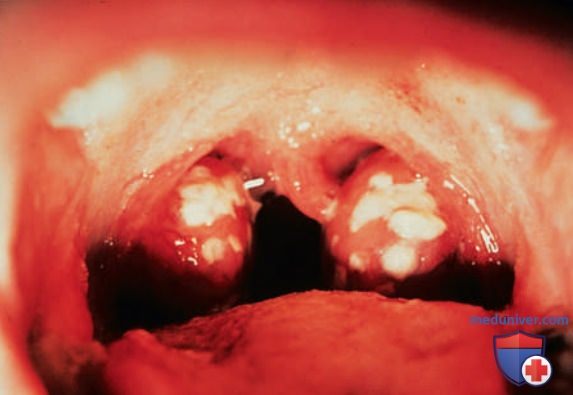 �������� ������������ ������ A (Streptococcus pyogenes)
