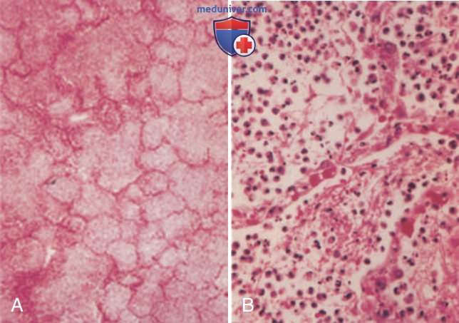 �������������� �������� (S. pneumoniae)