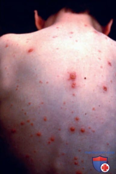 ����� Varicella zoster (����� �������� ���� � ������������� �����)