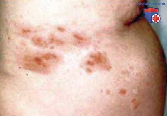 ����� Varicella zoster (����� �������� ���� � ������������� �����)