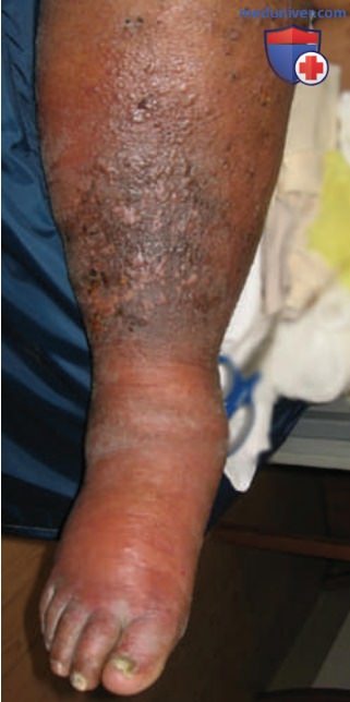 �������� Acinetobacter