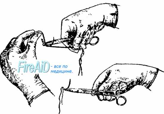 Надевание нитки на хирургическую иглу. Как держать иглодержатель гегара в руках?