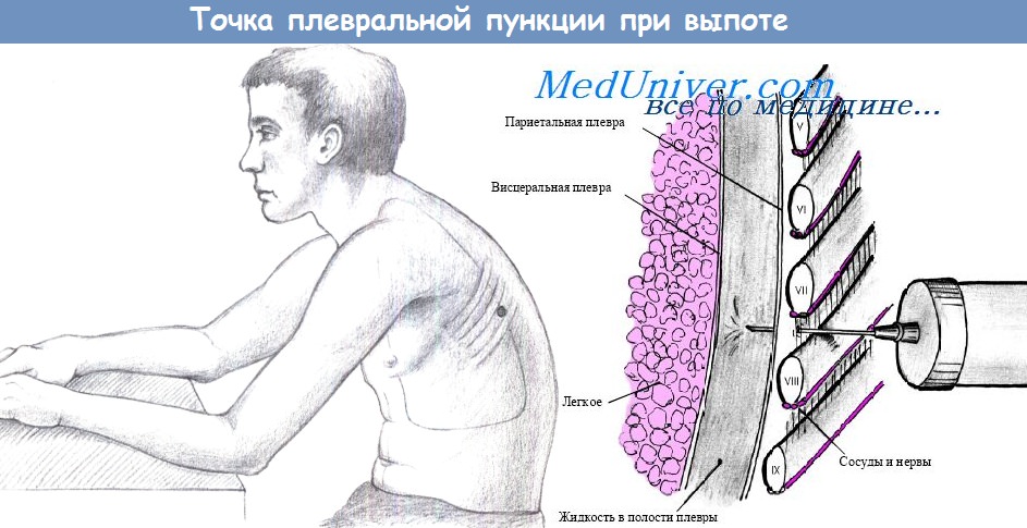 Гемоторакс. Классификация гемоторакса. Диагностика повреждений легкого. Пункция плевральной полости.