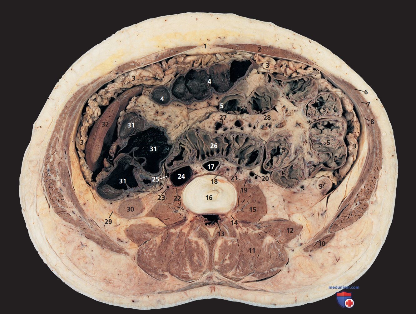 Анатомия аксиального среза живота через межпозвонковый диск второго и третьего поясничного позвонков (L2-L3)