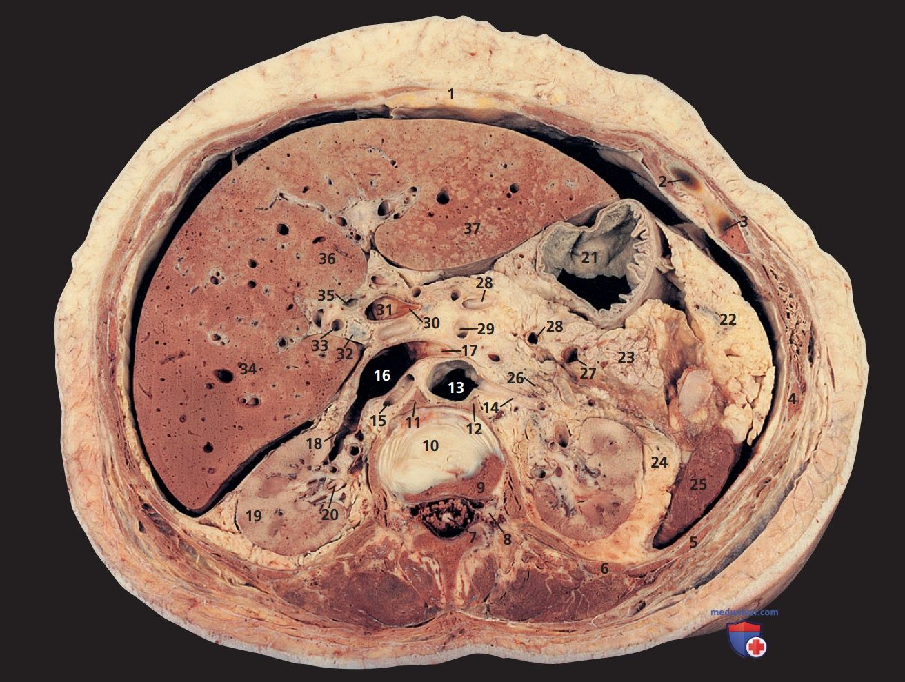 Анатомия аксиального среза живота женщины через межпозвонковый диск первого и второго поясничного позвонков (L1-L2)