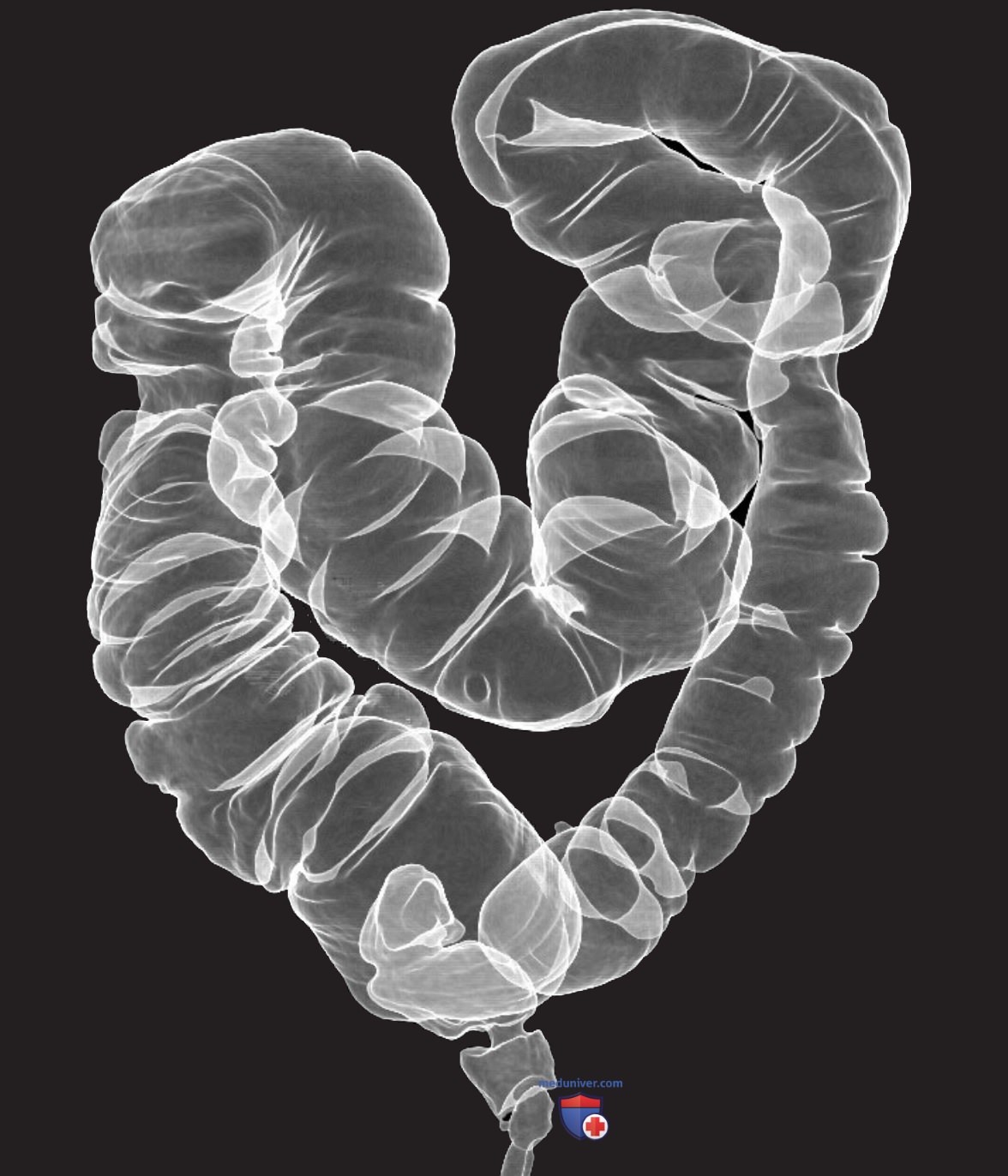 Анатомия толстой кишки на КТ колонографии (виртуальной колоноскопии)