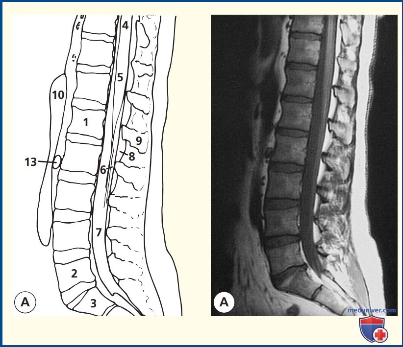 Анатомия сагиттального среза поясничного отдела позвоночника на магнитно-резонансной томограмме (МРТ)