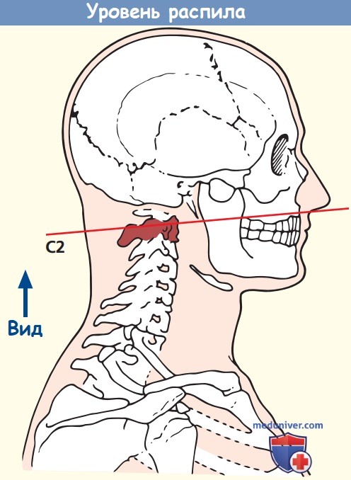 Альвеолярный гребень верхней и нижней челюсти, атрофия и пластика — ROOTT