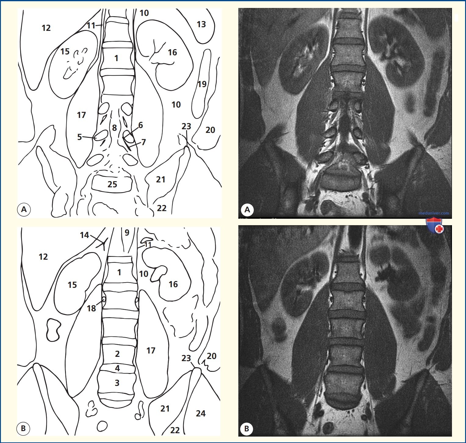 Анатомия коронального среза поясничного отдела позвоночника на магнитно-резонансной томограмме (МРТ)