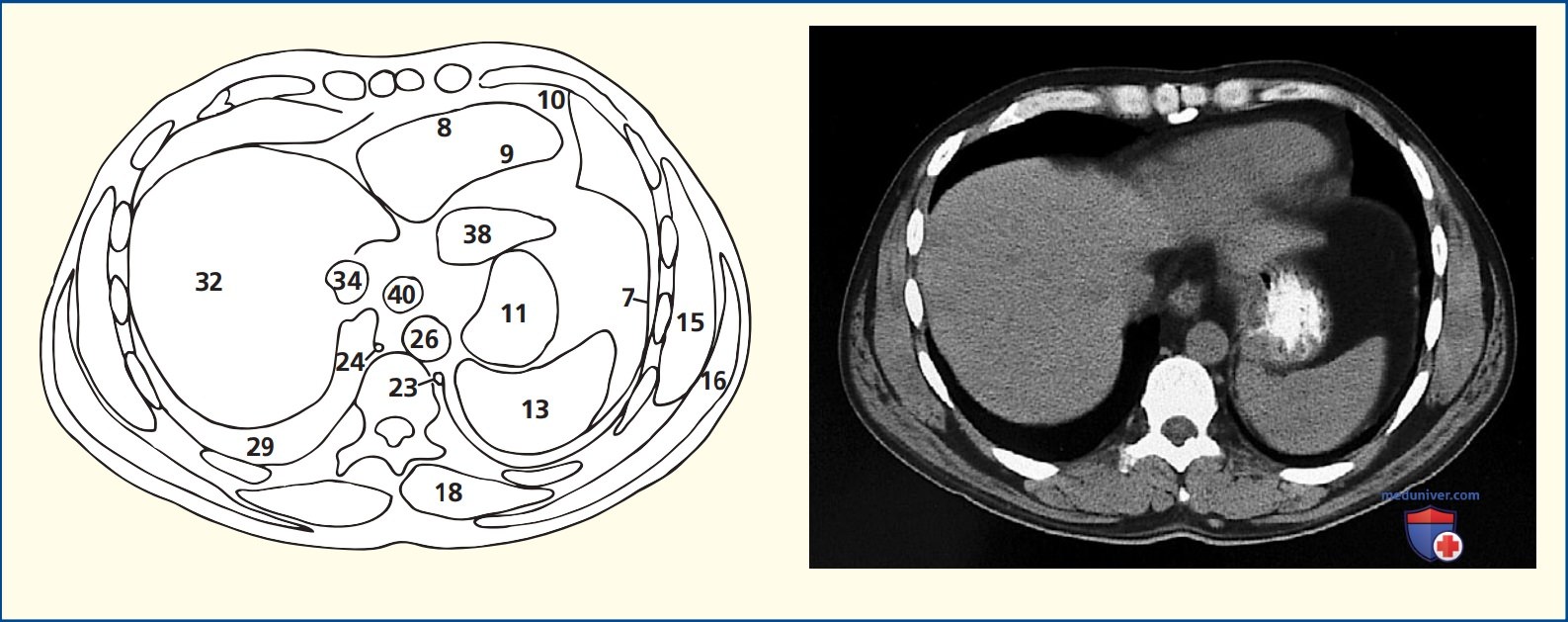 Анатомия аксиального среза живота через тело десятого грудного позвонка (Th10) и мечевидный отросток грудины