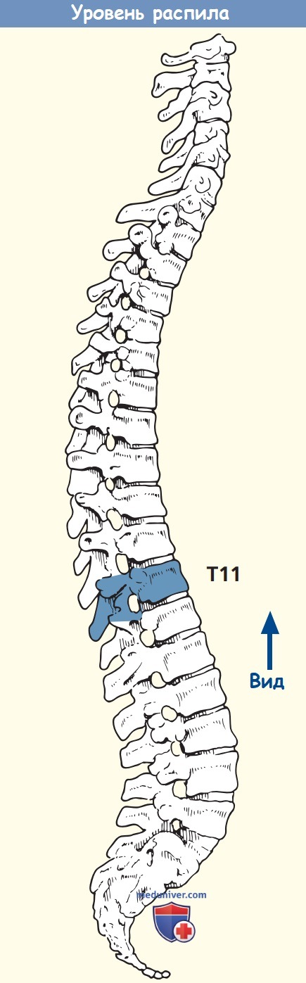 Анатомия аксиального среза живота через тело одиннадцатого грудного позвонка (Th11) и мечевидный отросток грудины