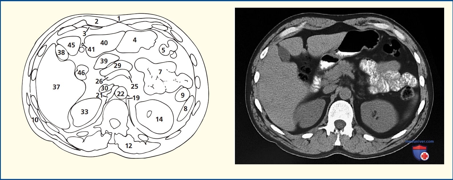 Анатомия аксиального среза живота через межпозвонковый диск двенадцатого грудного и первого поясничного позвонков (Th12-L1)