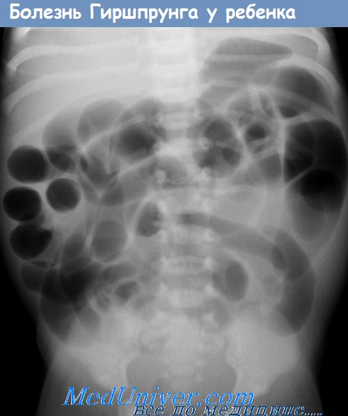 Рентгенограмма при болезни Гиршпрунга у ребенка