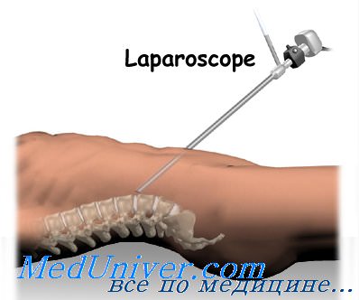 Лапароскопия. Значение лапароскопии