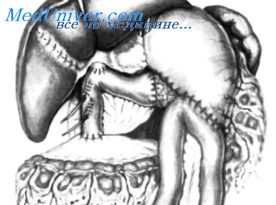 завершенный анастомоз поджелудочной железы и кишки
