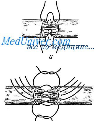 Микрохирургия сосудов и нервов thumbnail