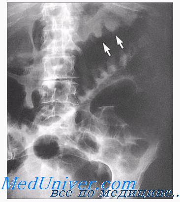 Обзорная рентгеноскопия(графия) брюшной полости. Аномальная локализация газа в брюшной полости.