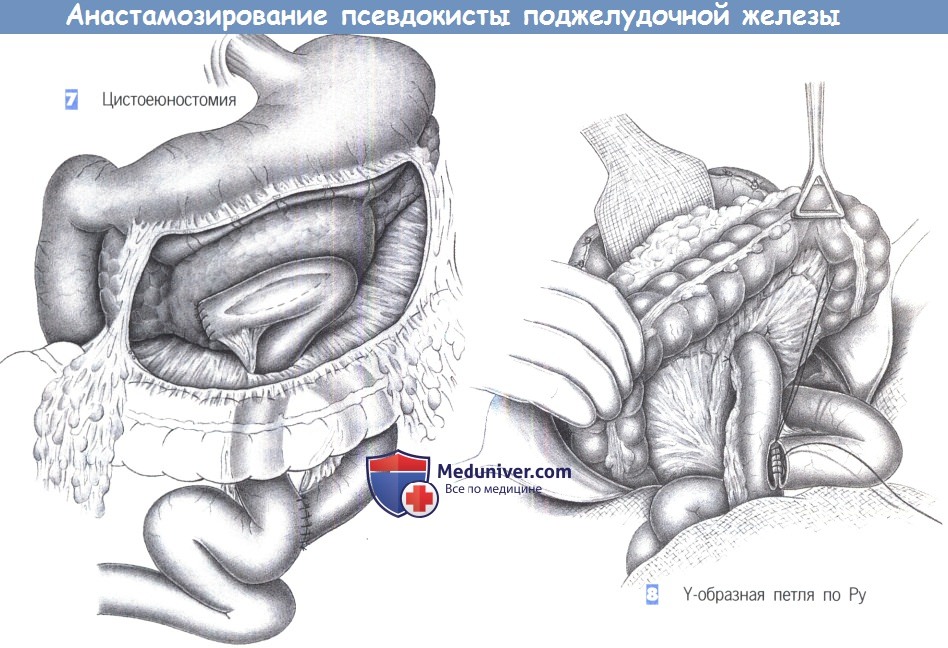 Этапы и техника анастамозирования псевдокисты поджелудочной железы с тонкой кишкой
