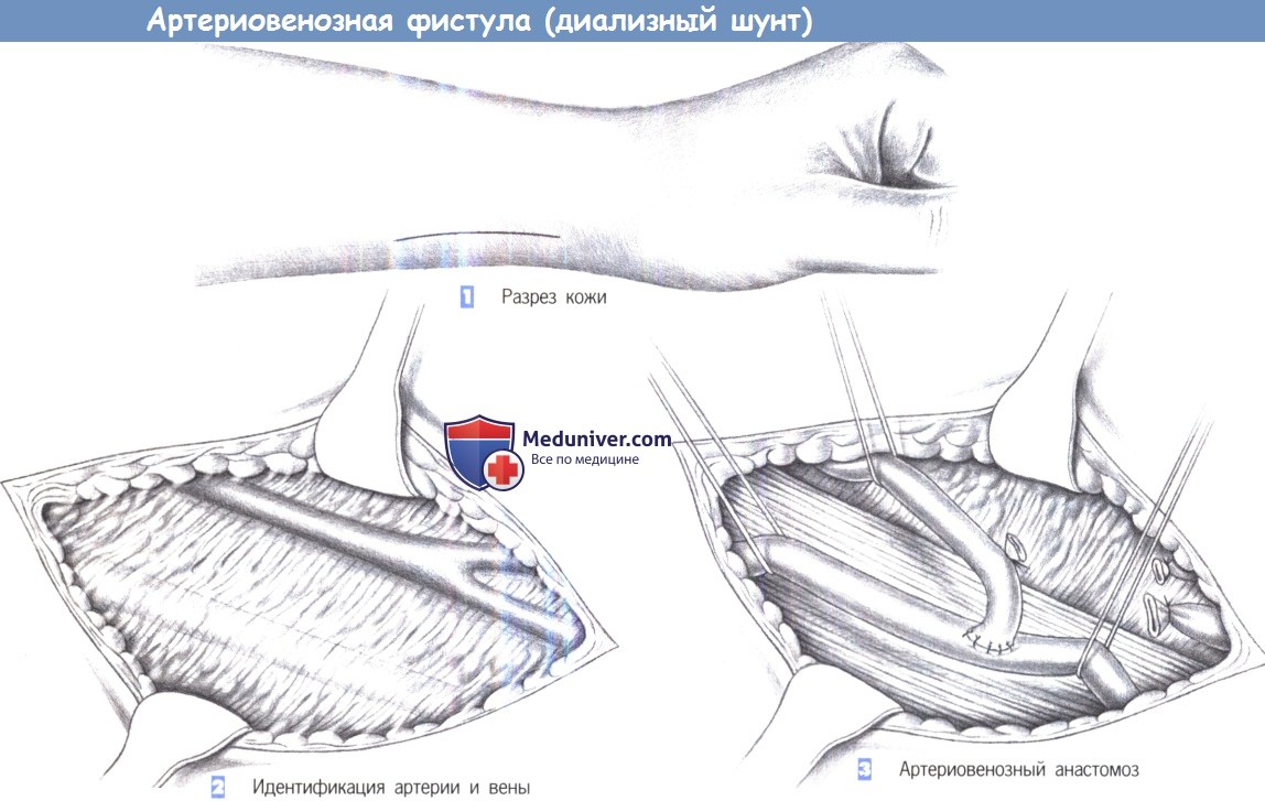 arteriovenoznaia fistula 1