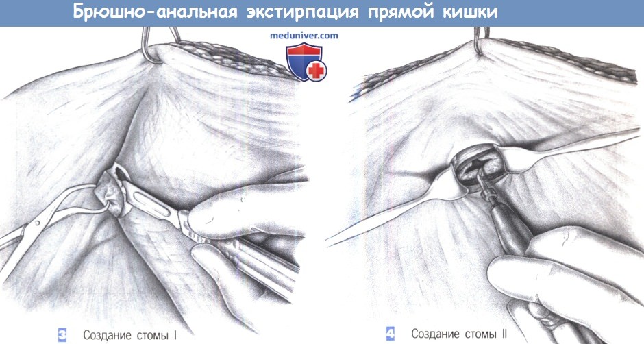 Этапы, техника брюшно-анальной резекции прямой кишки (экстирпации)