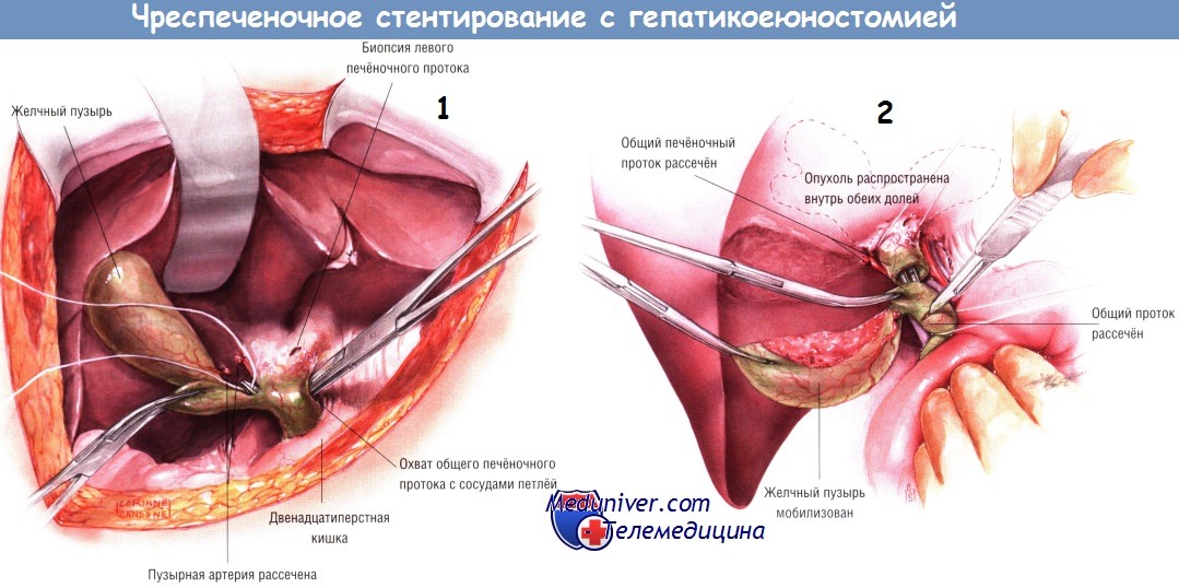 Ход операции чреспеченочного стентирования и гепатикоеюностомии