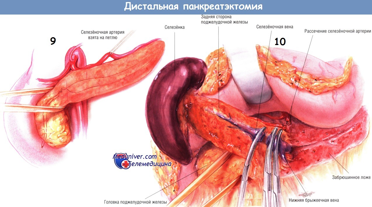 Методика операции дистальной панкреатэктомии