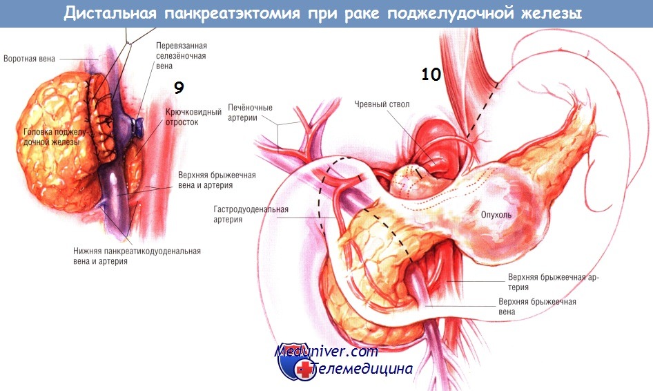 Методика операции дистальной панкреатэктомии при раке поджелудочной железы