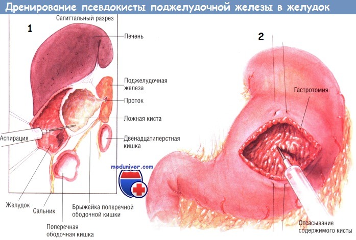 Методика операции дренирования псевдокисты поджелудочной железы в желудок