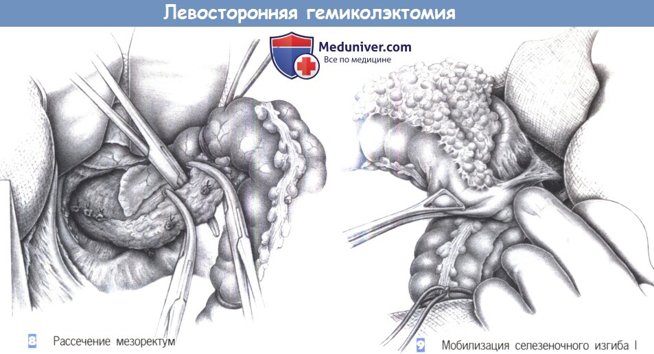 Этапы и техника гемиколэктомии слева