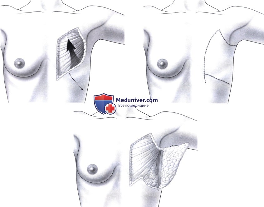 Грудонадчревный лоскут для пластики дефектов грудной стенки после мастэктомии