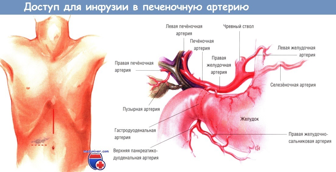 Доступ для инфузии в печеночную артерию (ИПА)