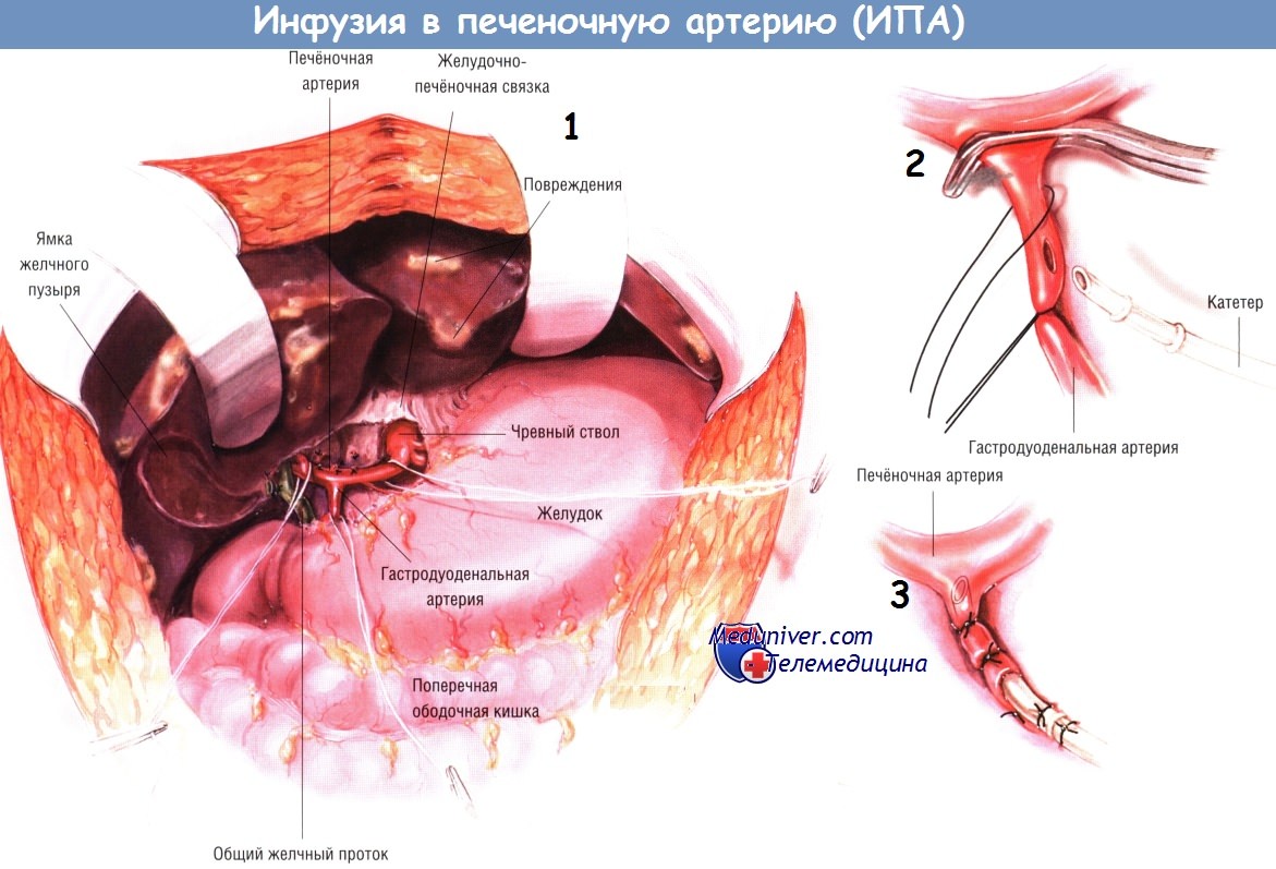 Методика инфузии в печеночную артерию (ИПА)