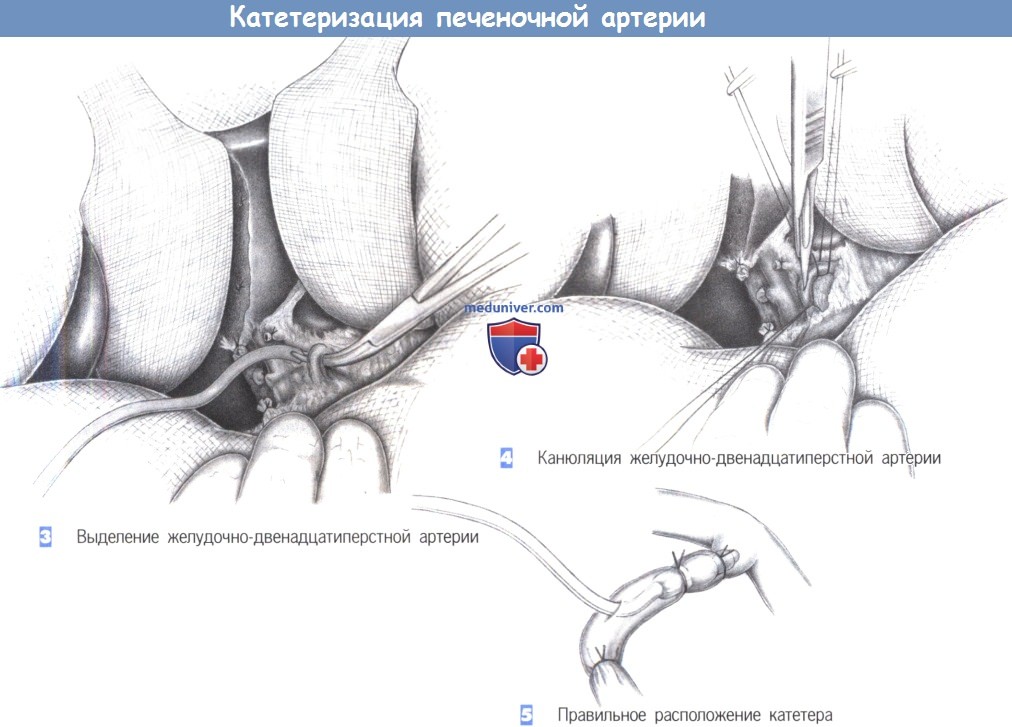 Катетеризация печеночной артерии