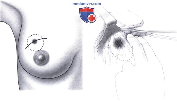 Лампэктомия (широкое иссечение) молочной железы