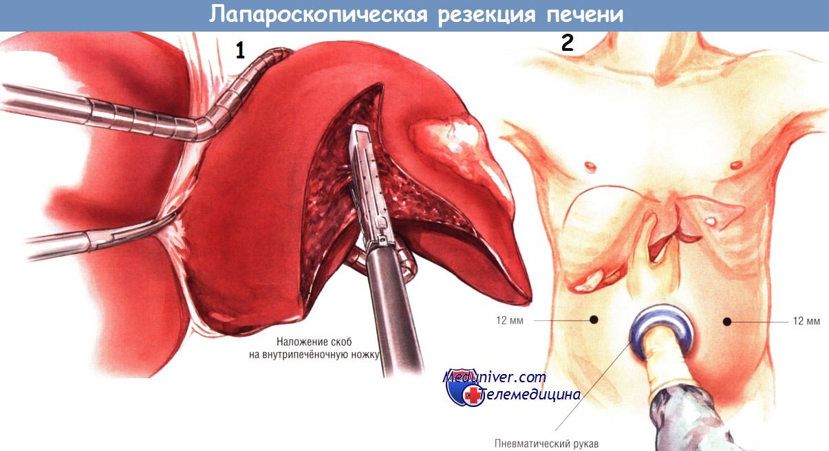 laparoskopicheskaia rezekcia pecheni 1