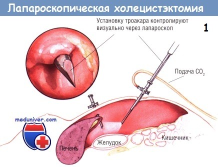 Методика лапароскопической холецистэктомии