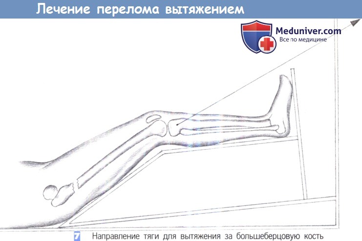 Техника лечения перелома ноги вытяжением