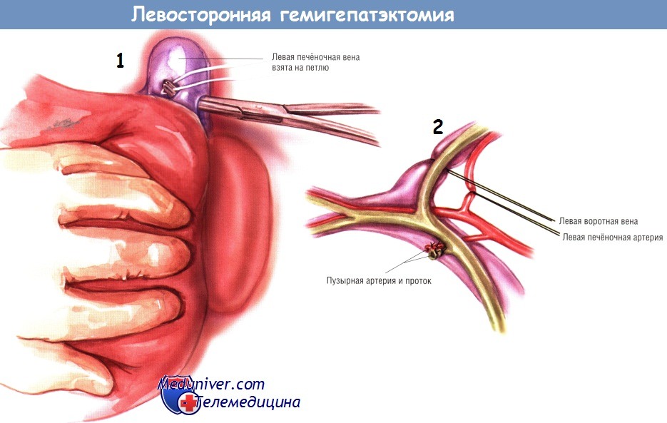 Ход операции левосторонней гемигепатэктомии