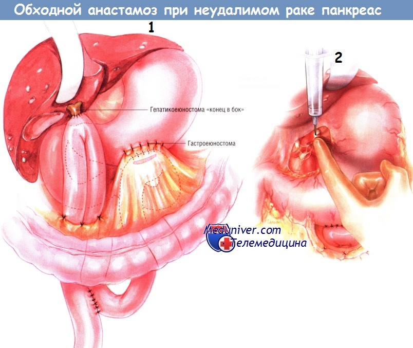 Методика наложения обходного анастомоза при неудалимом раке поджелудочной железы